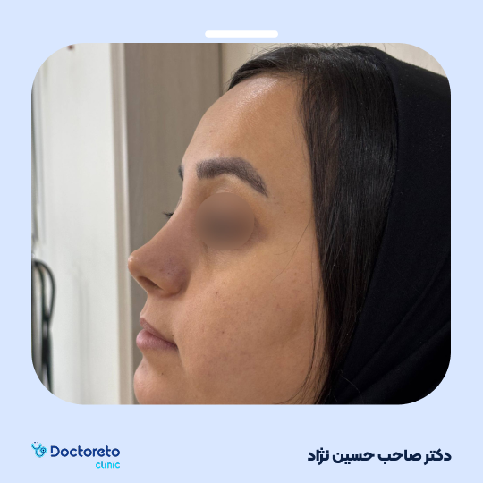 عمل جراحی مجدد زیبایی بینی (رینوپلاستی)