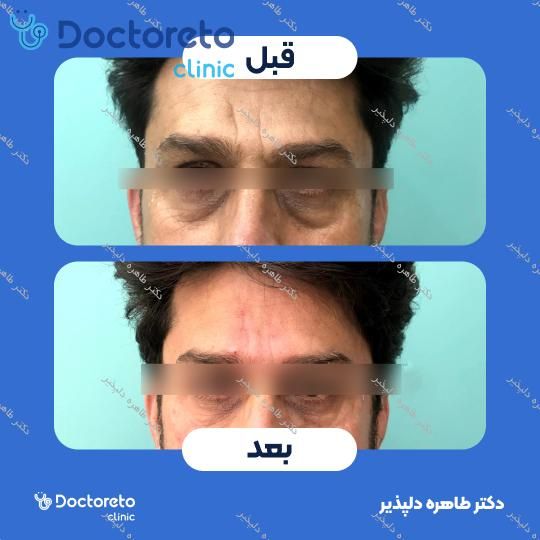 تزریق ژل زیر چشم