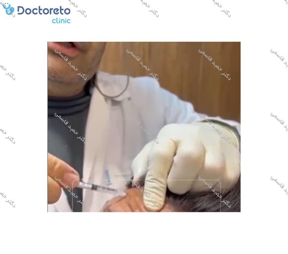 تزریق بوتاکس صورت (پیشانی، خط اخم، پنجه کلاغی)💉