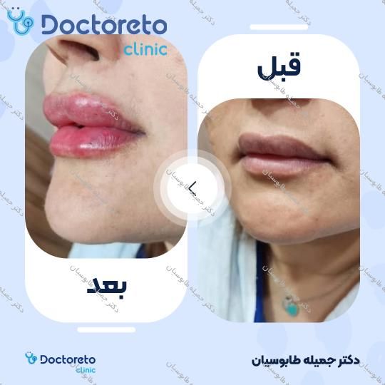 تزریق ژل لب