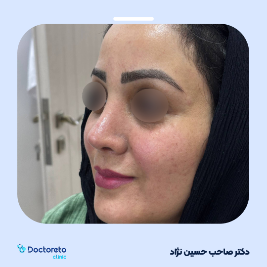 عمل زیبایی بینی استخوانی (رینوپلاستی)