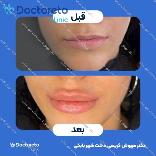 تزریق ژل لب