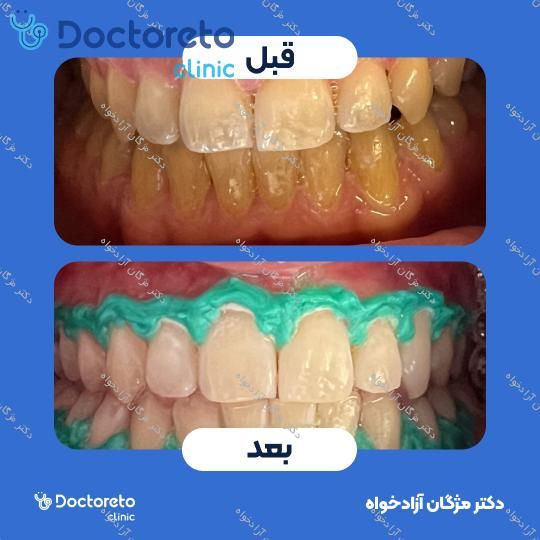 بلیچینگ دندان (سفید کردن دندان)