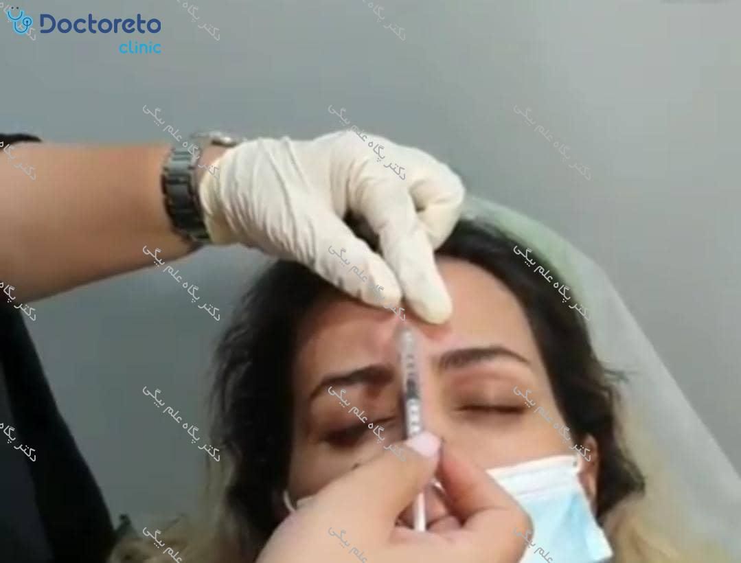 تزریق بوتاکس صورت (پیشانی، خط اخم، پنجه کلاغی)