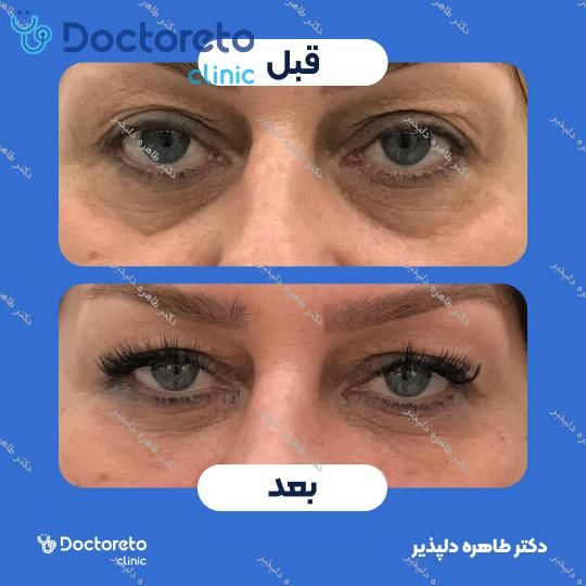 تزریق ژل زیر چشم