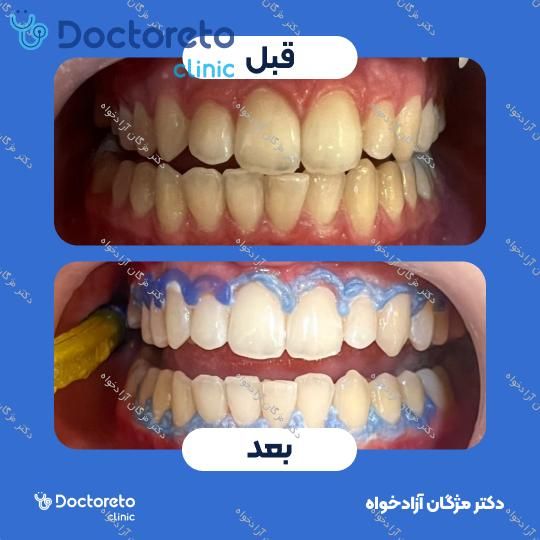 بلیچینگ دندان (سفید کردن دندان)