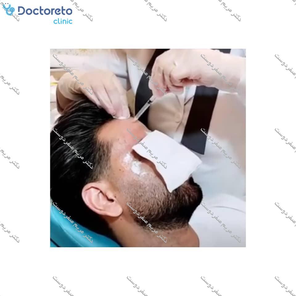 تزریق بوتاکس صورت (پیشانی، خط اخم، پنجه کلاغی)💉