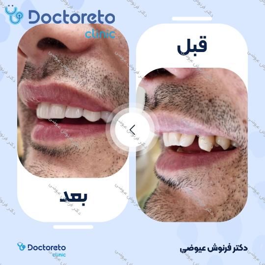 ونیر کامپوزیت (هر واحد)