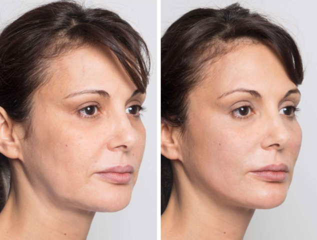 لیفت با نخ صورت