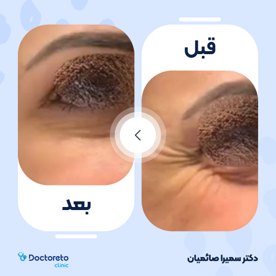 تزریق بوتاکس صورت (پیشانی، خط اخم، پنجه کلاغی)💉