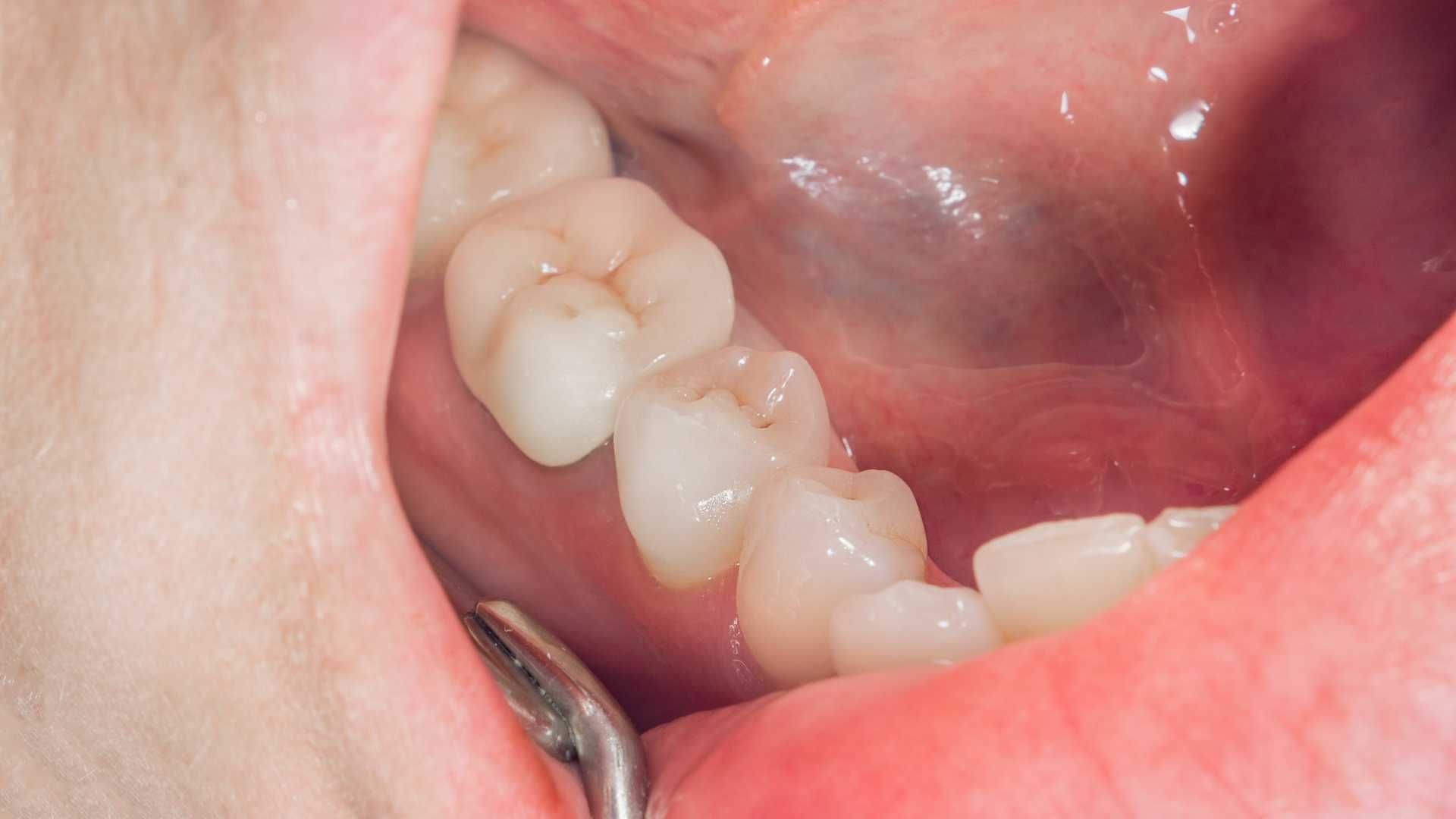 پر کردن دندان