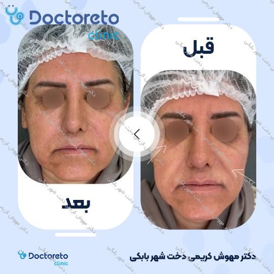 تزریق ژل خط خنده