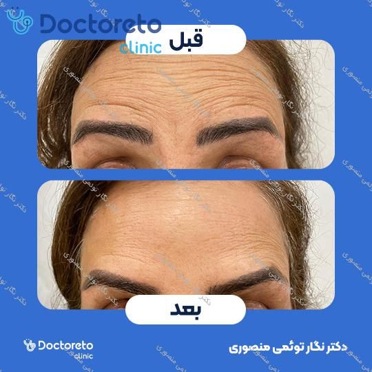 تزریق بوتاکس صورت (پیشانی، خط اخم، پنجه کلاغی)💉