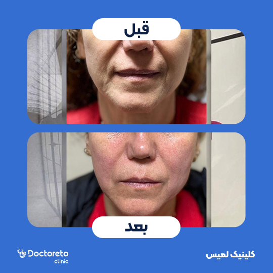 تزریق ژل چانه