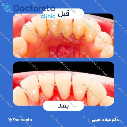 جرم گیری کامل دندان‌های دو فک با بروساژ🦷