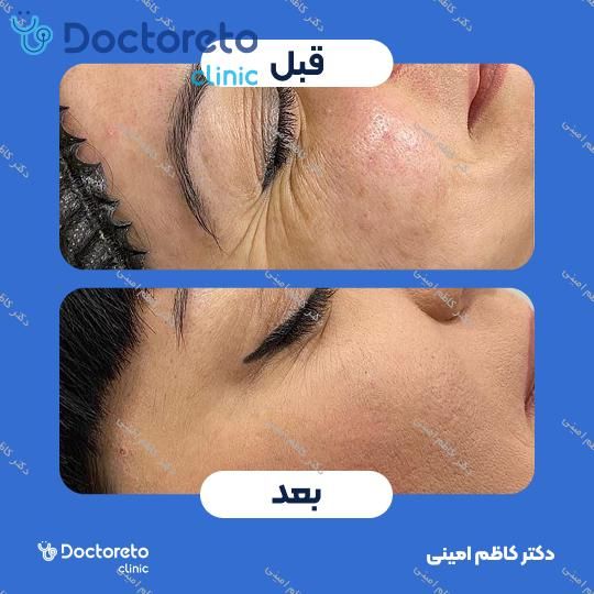 تزریق بوتاکس صورت (پیشانی، خط اخم، پنجه کلاغی)💉