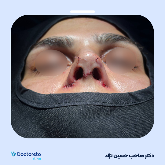 جراحی انحراف بینی (سپتوپلاستی)