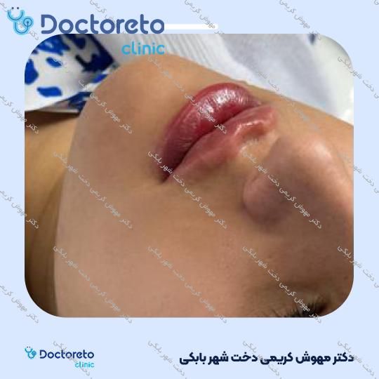 تزریق ژل لب