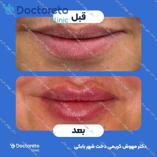 تزریق ژل لب