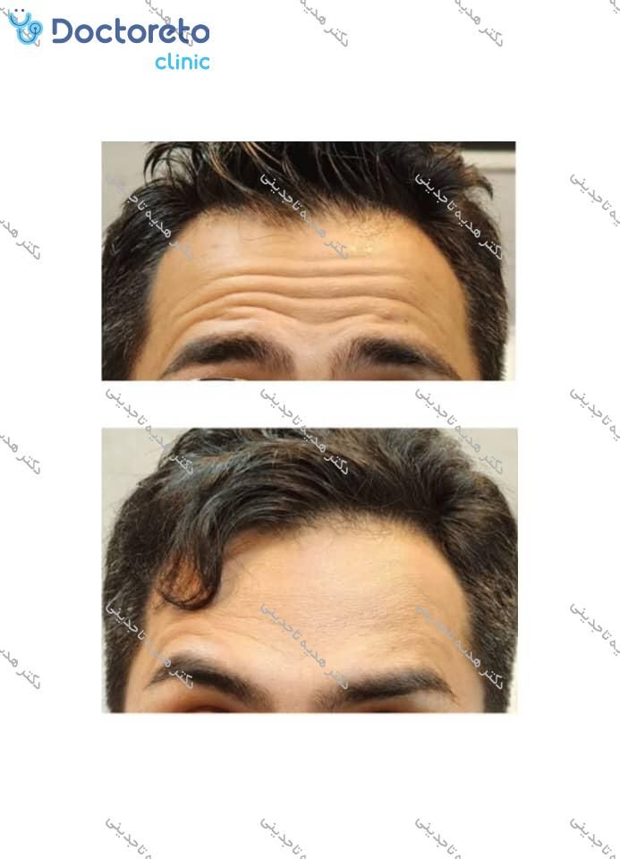 تزریق بوتاکس صورت (پیشانی، خط اخم، پنجه کلاغی)💉