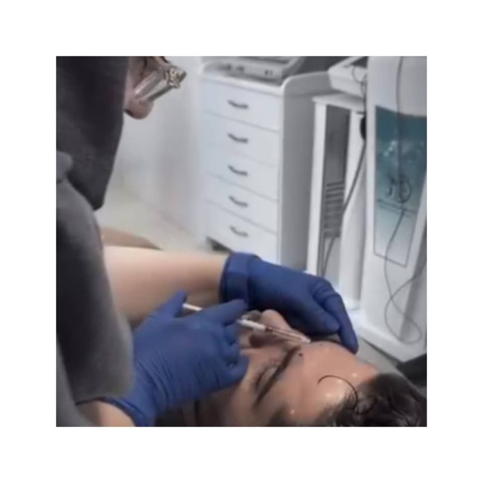تزریق بوتاکس صورت (پیشانی، خط اخم، پنجه کلاغی)