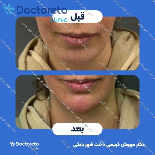 تزریق ژل چانه