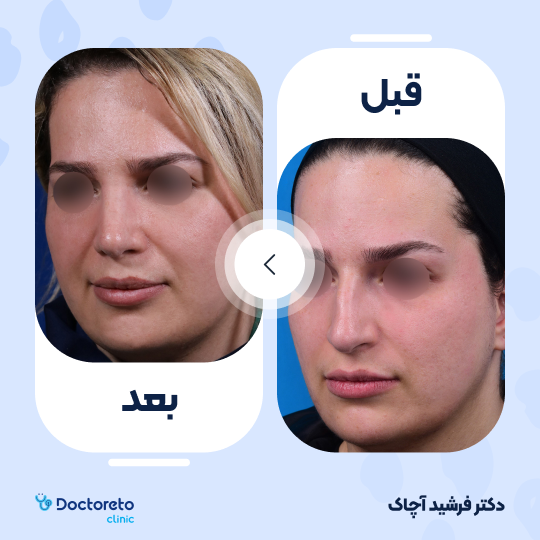 عمل جراحی ترمیمی زیبایی بینی (رینوپلاستی)