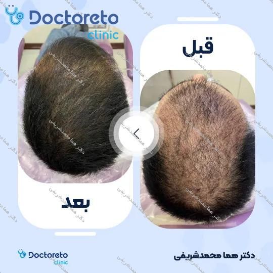 جوانسازی و روشن سازی سیاهی دور چشم با روش پلاسما تراپی