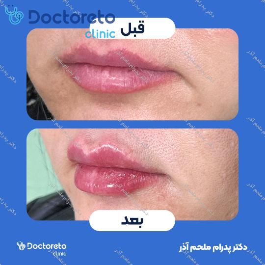 تزریق ژل لب