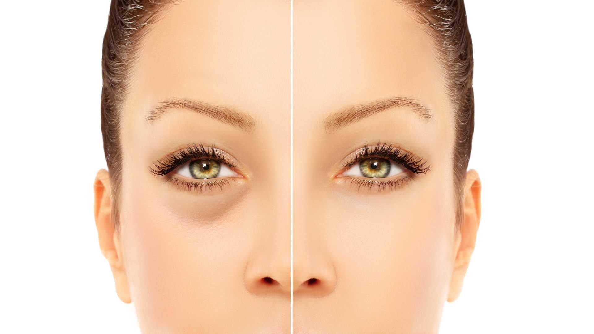 جوانسازی و روشن سازی سیاهی دور چشم با روش پلاسما تراپی