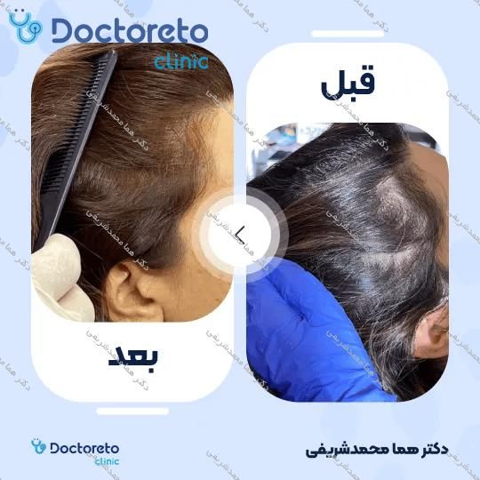 درمان ریزش موی سر با تزریق مزوتراپی (هرجلسه)