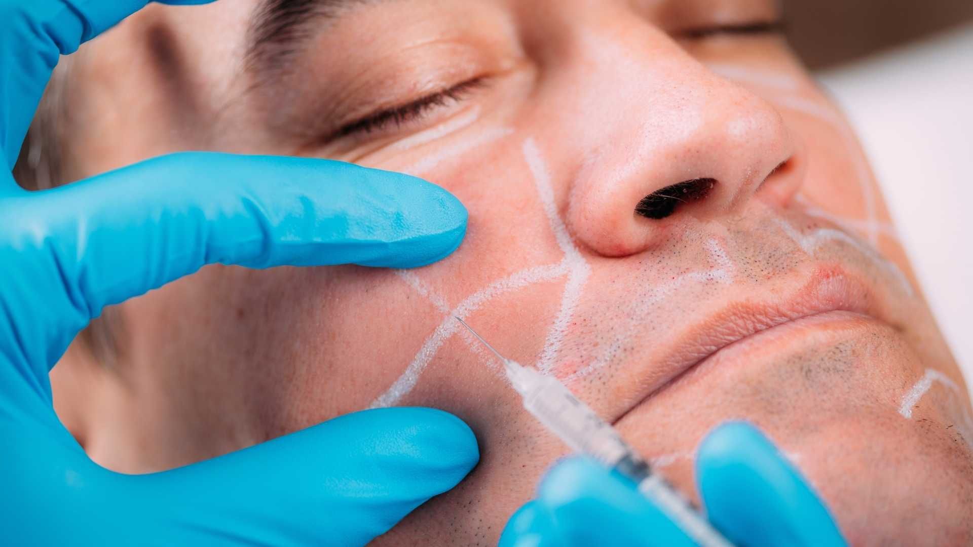 تزریق ژل گونه