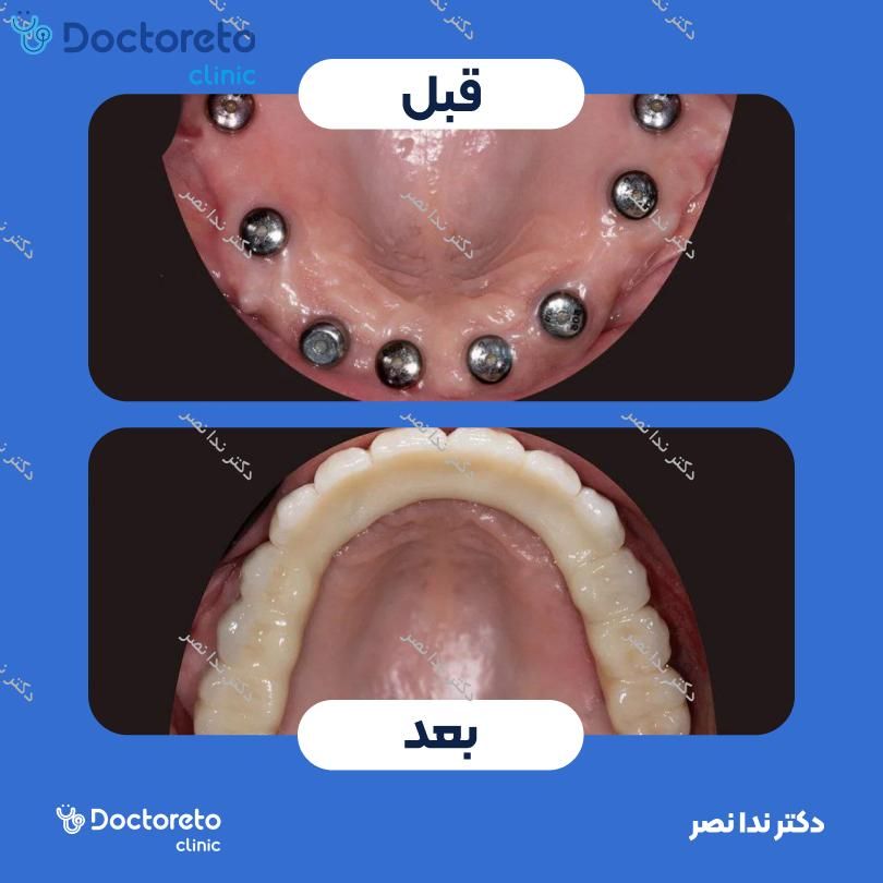 ایمپلنت دندان با روکش (هر واحد)