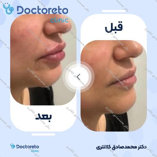 تزریق ژل لب