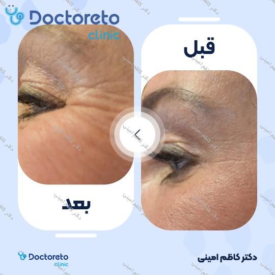 تزریق بوتاکس صورت (پیشانی، خط اخم، پنجه کلاغی)💉