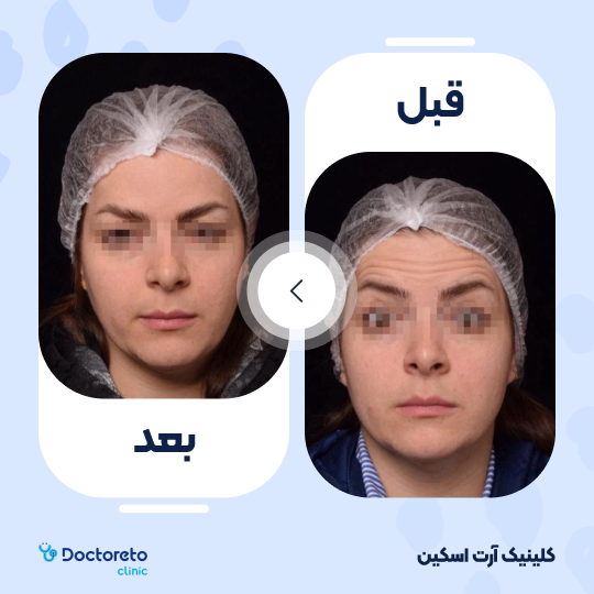 تزریق بوتاکس صورت (پیشانی، خط اخم، پنجه کلاغی)💉