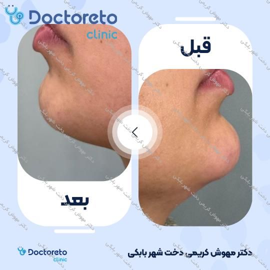 تزریق ژل چانه