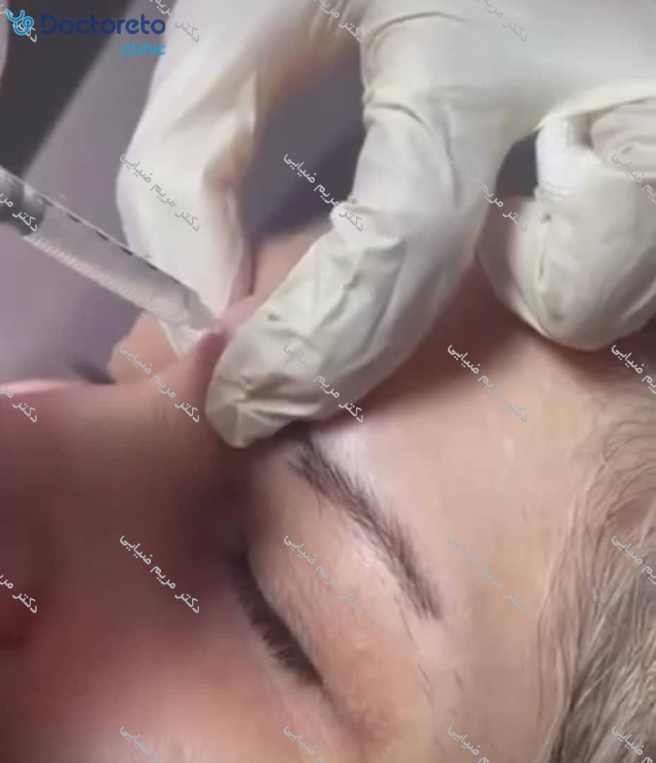 تزریق بوتاکس صورت (پیشانی، خط اخم، پنجه کلاغی)