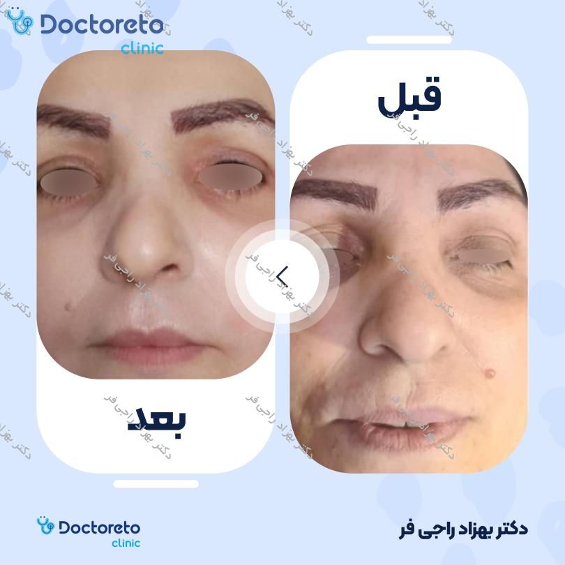 تزریق ژل گونه