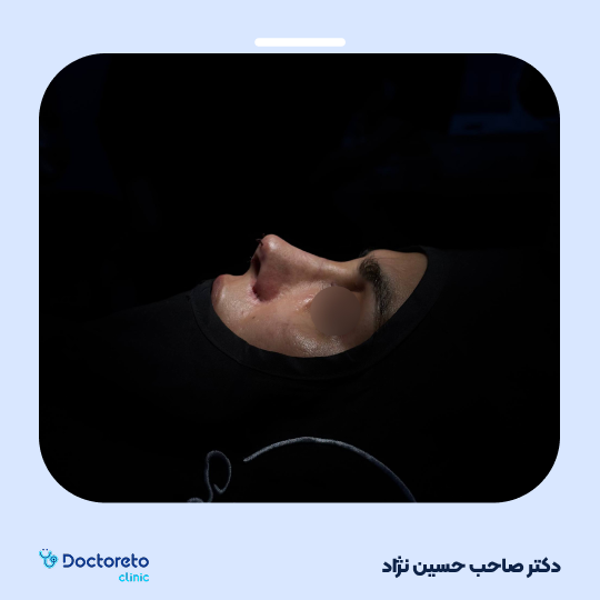 عمل زیبایی بینی گوشتی (رینوپلاستی)