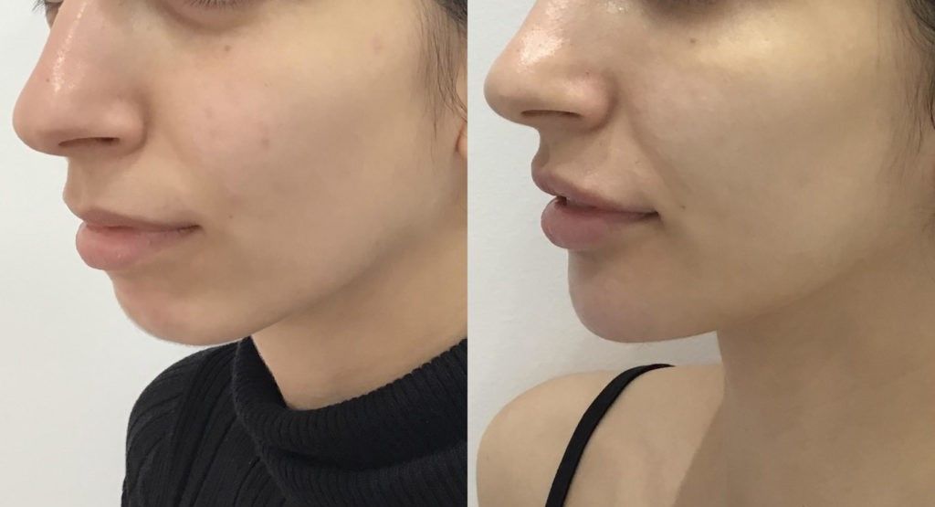 تزریق ژل چانه