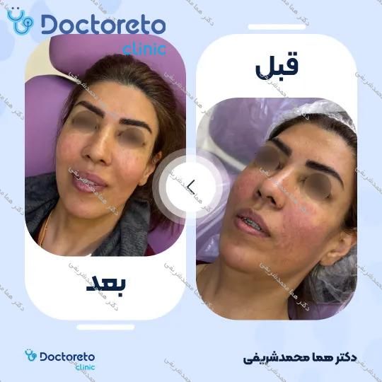 تزریق ژل لب