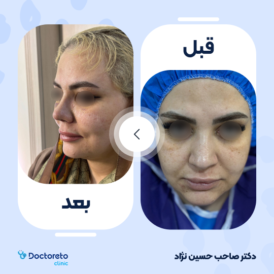 عمل زیبایی بینی استخوانی (رینوپلاستی)