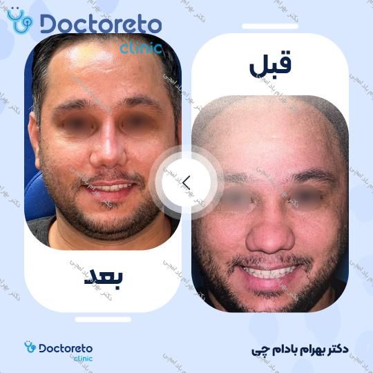 عمل زیبایی بینی گوشتی (رینوپلاستی)