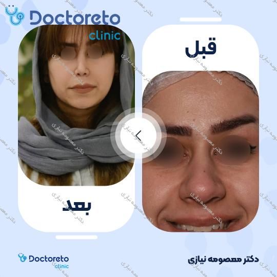 عمل جراحی مجدد زیبایی بینی (رینوپلاستی)