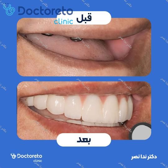 ایمپلنت دندان با روکش (هر واحد)