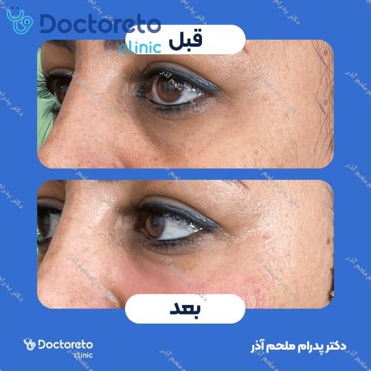 تزریق ژل زیرچشم