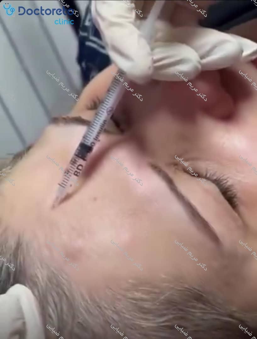 تزریق بوتاکس صورت (پیشانی، خط اخم، پنجه کلاغی)