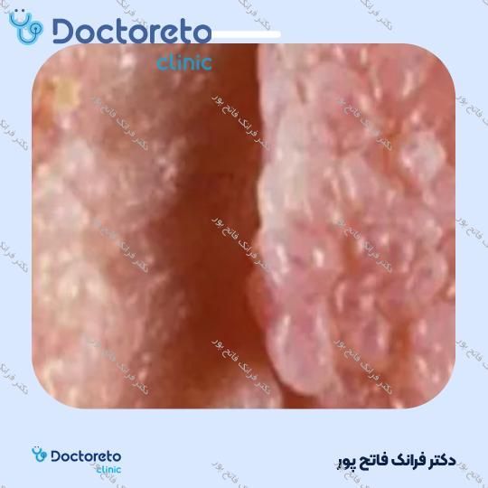 برداشتن زگیل تناسلی بانوان (هر عدد)