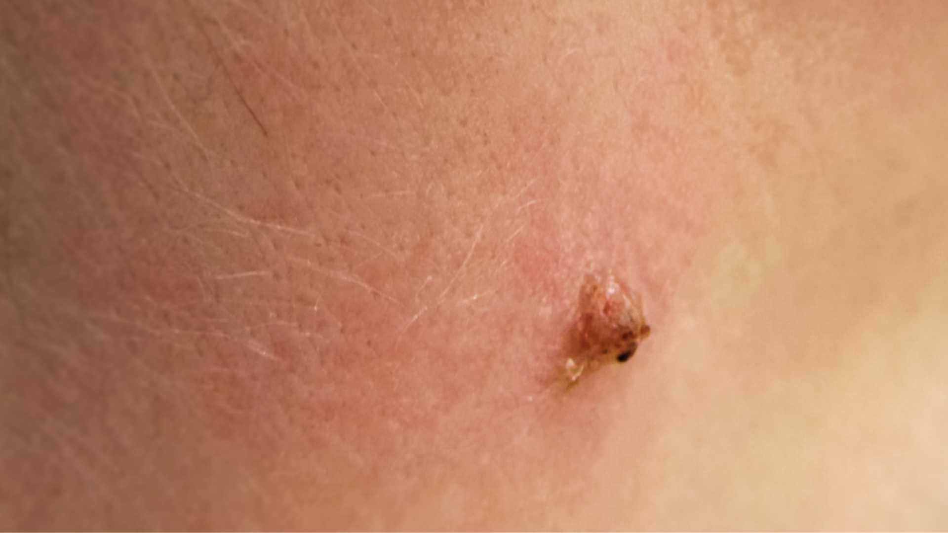 برداشتن زگیل تناسلی بانوان (هر عدد)